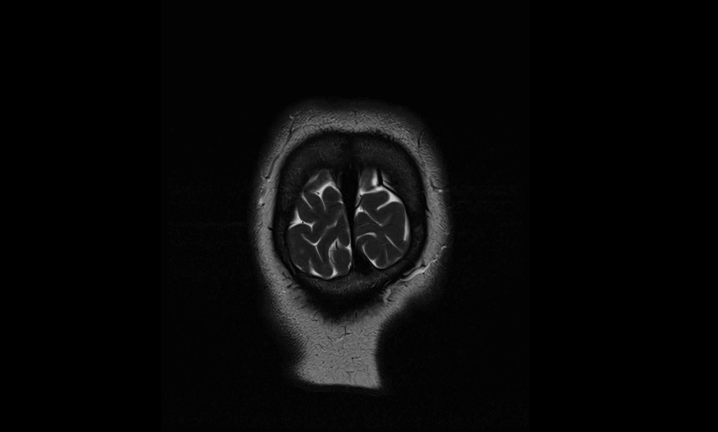 Brain cisterns  and ventricles coronal anatomy 3T MRI image-img-00001-00063.webp